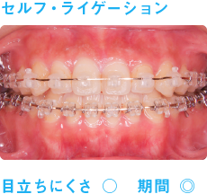 セルフ・ライゲーション・ブラケット