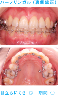 ハーフリンガル（裏側矯正）